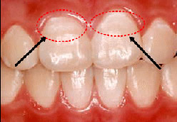歯表面白濁化(初期う蝕)