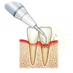 歯周病⑤歯周病初期治療って？