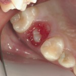 子供の歯の虫歯治療