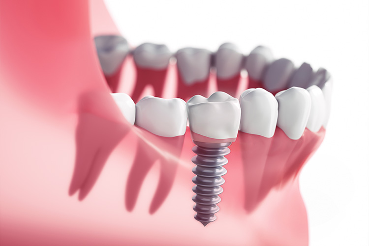 C4：歯質が失われた虫歯