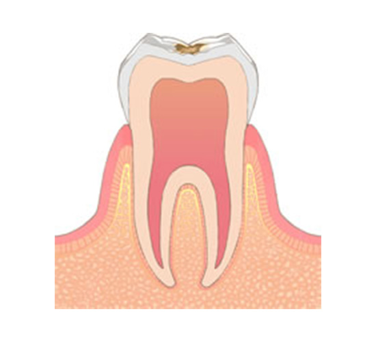 C1：エナメル質内の虫歯