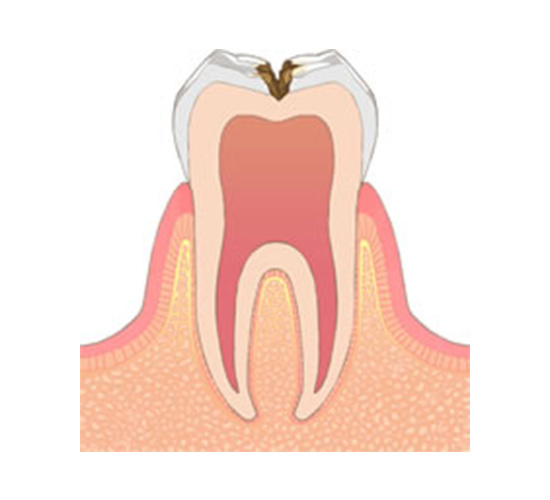 C2：象牙質に達した虫歯