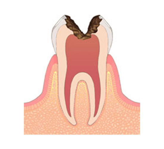 C3：歯髄（神経）に達した虫歯