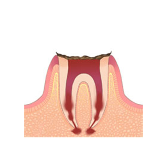 C4：歯質が失われた虫歯