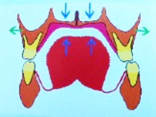 口腔筋機能療法
