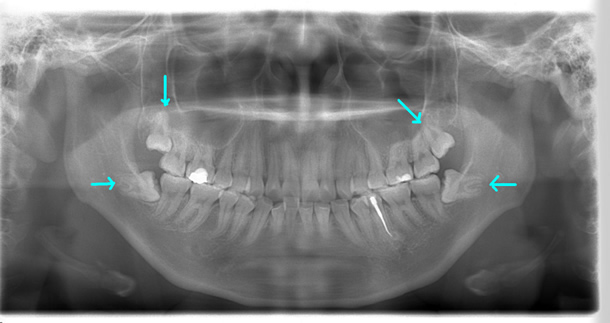 親知らずの抜歯が必要な症例