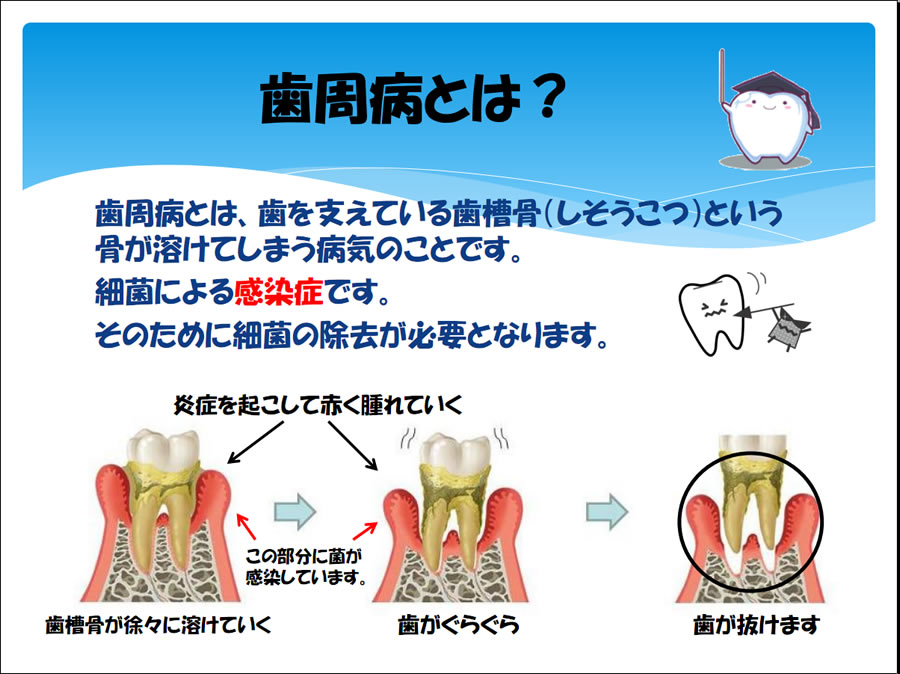 歯周病とは