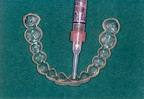 ホワイトニング