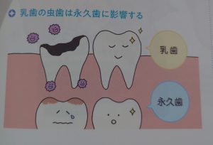 乳歯の虫歯
